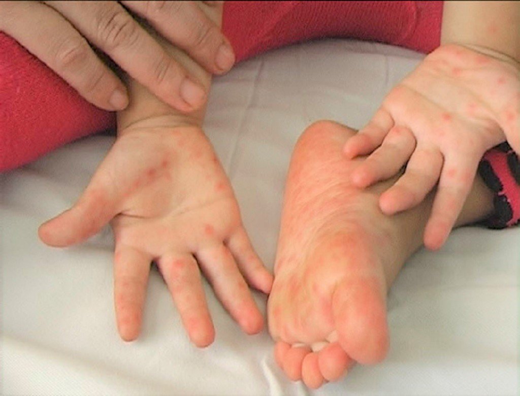 Bệnh tay chân miệng là một bệnh lây nhiễm dễ gây thành dịch