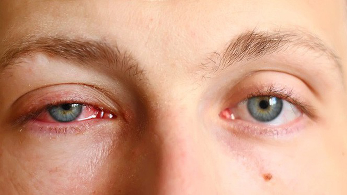 Cách phòng tránh bệnh đau mắt đỏ rất dễ dàng
