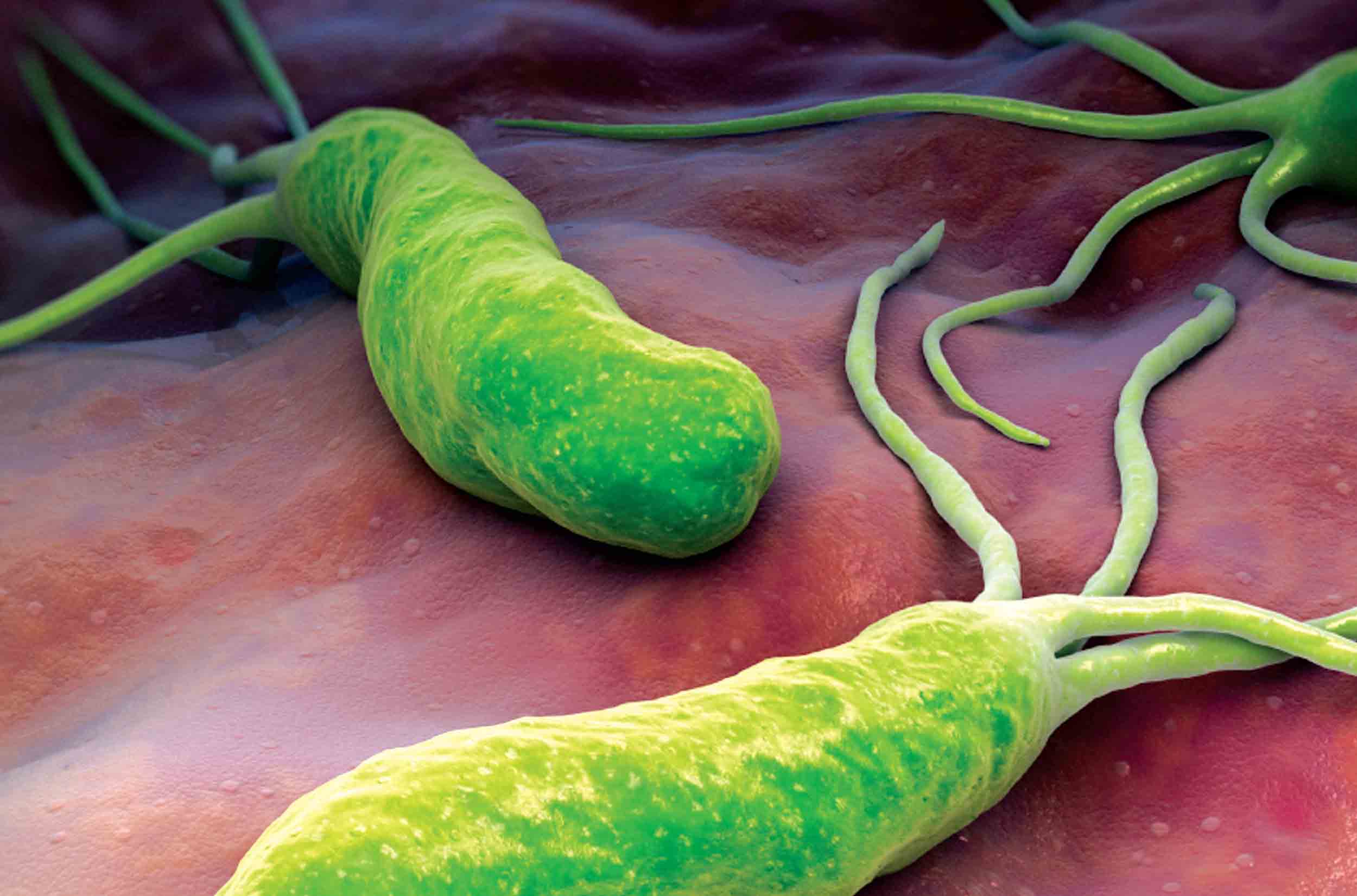 Viêm dạ dày nguyên phát được biết do nhiễm helicobacter pylori (HP)