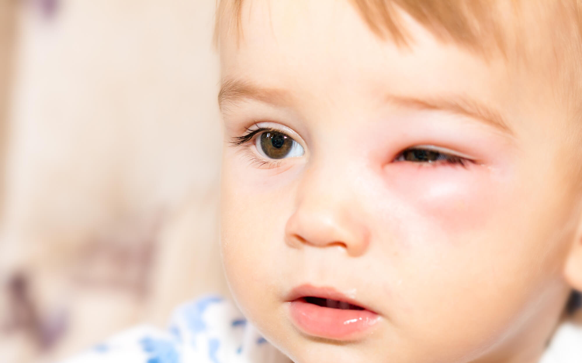 Bệnh đau mắt đỏ là một bệnh không quá nguy hiểm nếu biết điều trị