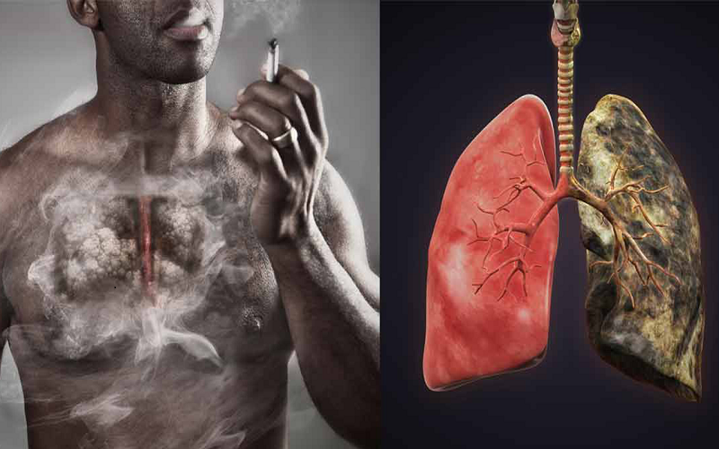 Nhận biết ung thư phổi qua nhận dấu hiệu sau bạn không thể bỏ qua