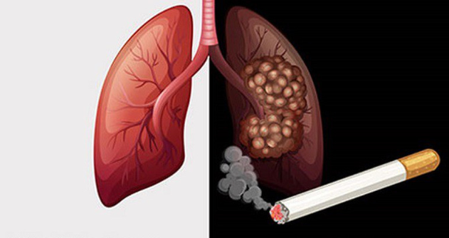 Hút thuốc lá - Nguyên nhân hàng đầu gây ung thư phổi bạn đã biết
