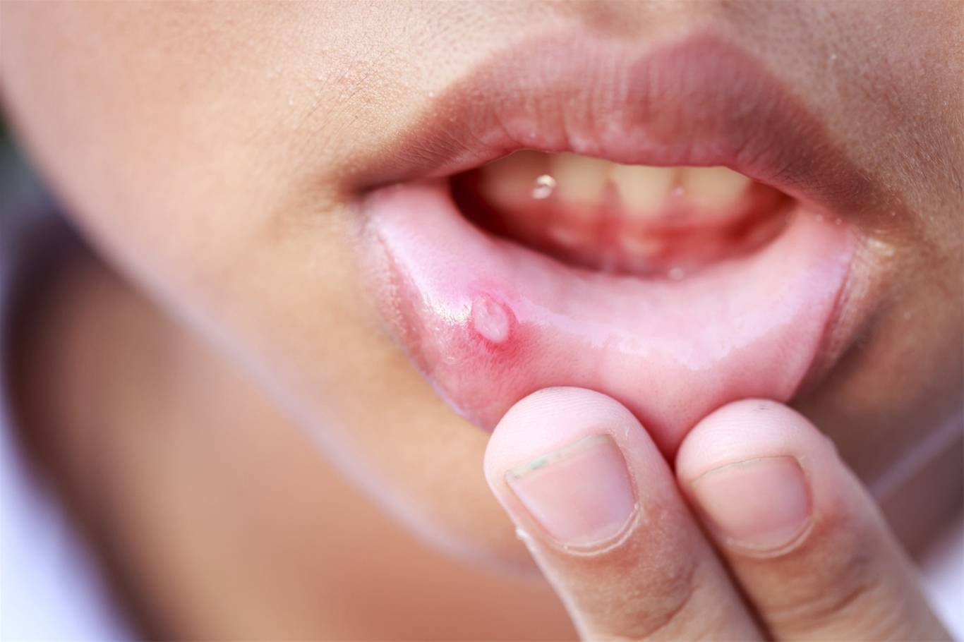 Miệng xuất hiện vết đẹn có nguy hiểm không?