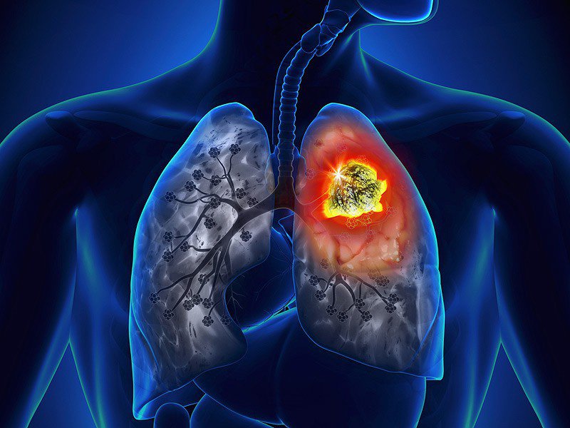 Thực trạng ung thư phổi tại Việt Nam